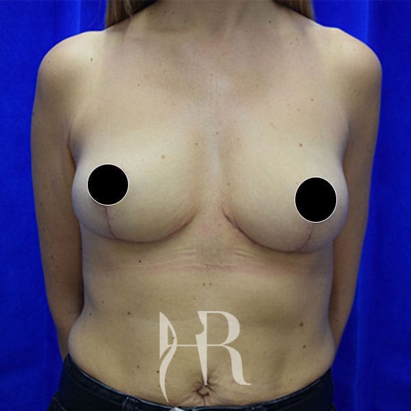HR Plastic Surgery - Breast Uplift patient after 9