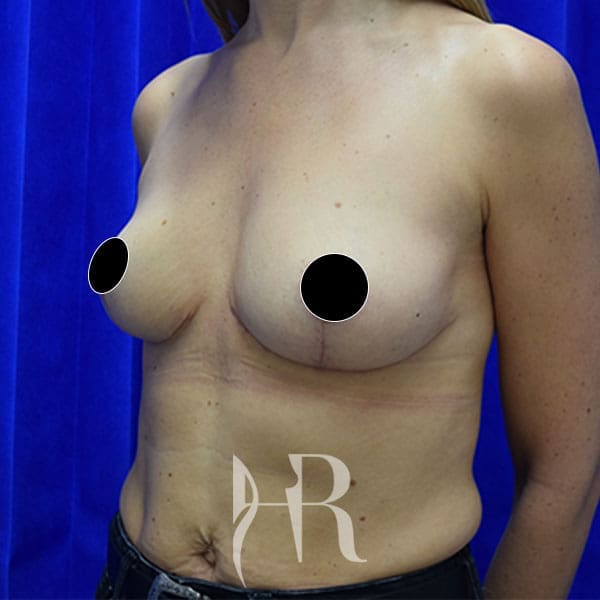HR Plastic Surgery - Breast Uplift patient after 8