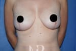 HR Plastic Surgery - Breast Uplift patient after 5