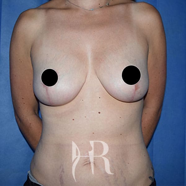 HR Plastic Surgery - Breast Uplift patient after 5