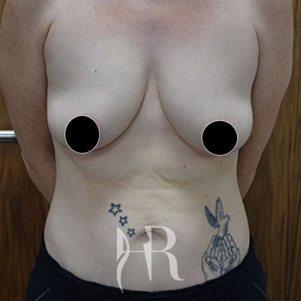 HR Plastic Surgery - Breast Uplift patient before 14