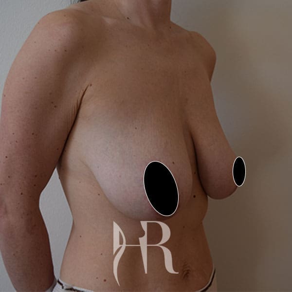 HR Plastic Surgery - Breast Uplift patient before 4