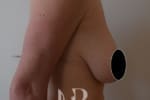 HR Plastic Surgery - Breast Uplift patient before 6