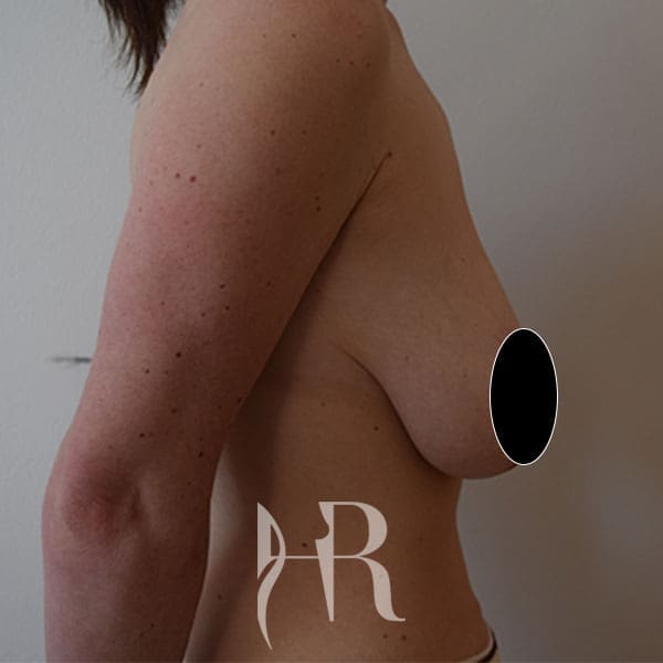 HR Plastic Surgery - Breast Uplift patient before 6
