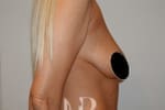 HR Plastic Surgery - Breast Uplift patient before 10