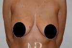 HR Plastic Surgery - Breast Uplift patient before 12
