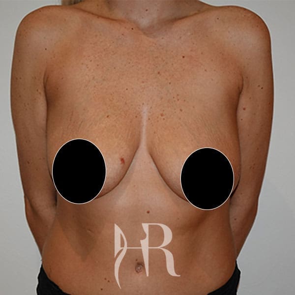 HR Plastic Surgery - Breast Uplift patient before 12