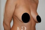 HR Plastic Surgery - Breast Uplift patient before 11
