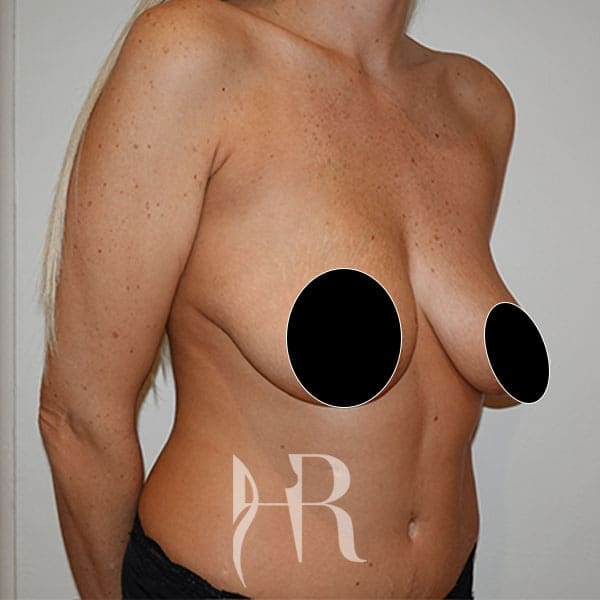 HR Plastic Surgery - Breast Uplift patient before 11