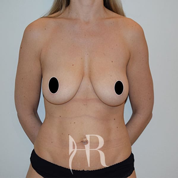 HR Plastic Surgery - Breast Uplift patient before 9