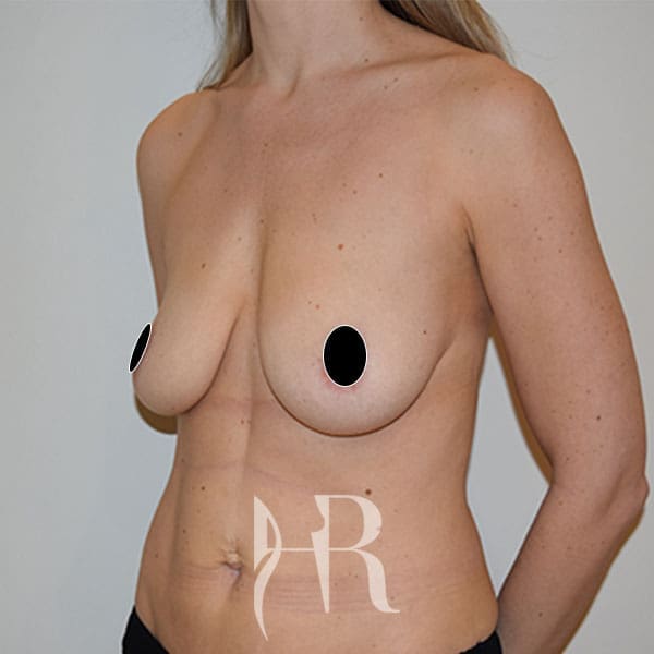 HR Plastic Surgery - Breast Uplift patient before 8