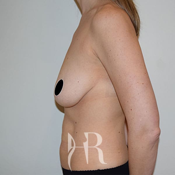 HR Plastic Surgery - Breast Uplift patient before 7