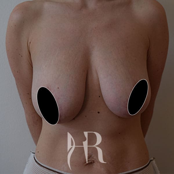 HR Plastic Surgery - Breast Uplift patient before 5
