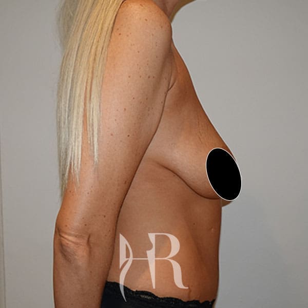 HR Plastic Surgery - Breast Uplift patient before 10