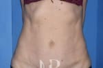 HR Plastic Surgery - Mini Tummy Tuck patient after 1