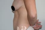 HR Plastic Surgery - Mini Tummy Tuck patient after 6