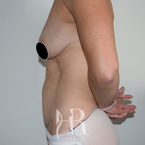 HR Plastic Surgery - Mini Tummy Tuck patient after 6