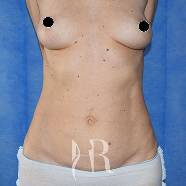 HR Plastic Surgery - Mini Tummy Tuck patient before 1