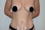 HR Plastic Surgery - Mini Tummy Tuck patient before 4