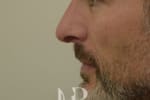 HR Plastic Surgery - Nose Reshaping (Rhinoplasty) patient after 1