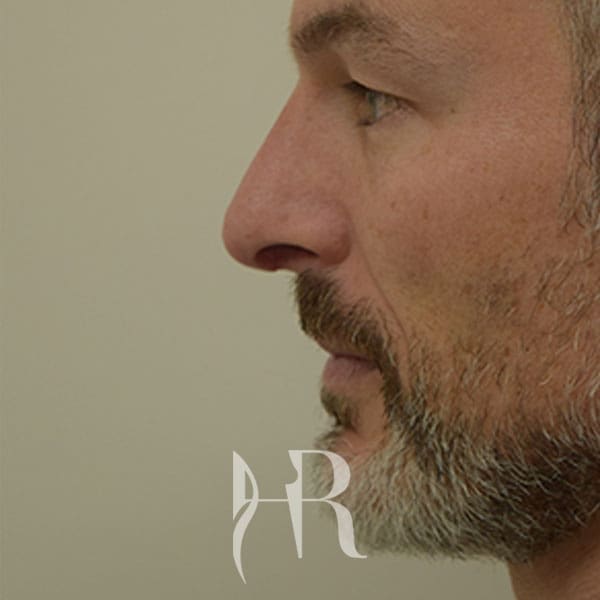 HR Plastic Surgery - Nose Reshaping (Rhinoplasty) patient after 1