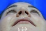 HR Plastic Surgery - Nose Reshaping (Rhinoplasty) patient after 10