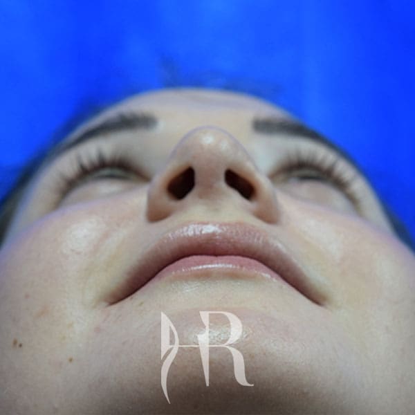 HR Plastic Surgery - Nose Reshaping (Rhinoplasty) patient after 10