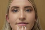 HR Plastic Surgery - Nose Reshaping (Rhinoplasty) patient after 11