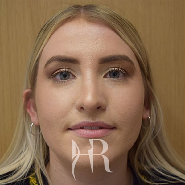 HR Plastic Surgery - Nose Reshaping (Rhinoplasty) patient after 11
