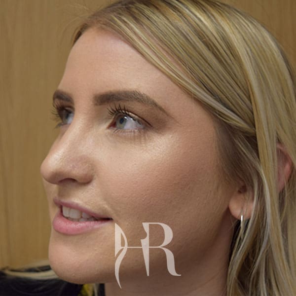 HR Plastic Surgery - Nose Reshaping (Rhinoplasty) patient after 12