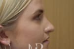 HR Plastic Surgery - Nose Reshaping (Rhinoplasty) patient after 13