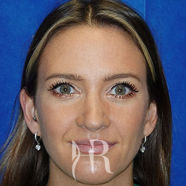 HR Plastic Surgery - Nose Reshaping (Rhinoplasty) patient after 14