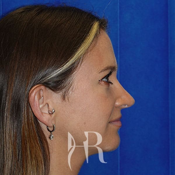 HR Plastic Surgery - Nose Reshaping (Rhinoplasty) patient after 16