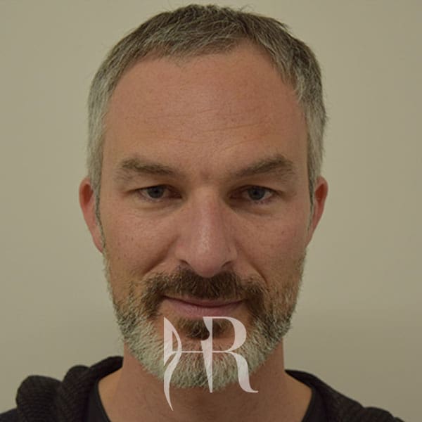 HR Plastic Surgery - Nose Reshaping (Rhinoplasty) patient after 3