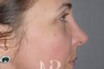 HR Plastic Surgery - Nose Reshaping (Rhinoplasty) patient after 4