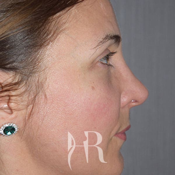HR Plastic Surgery - Nose Reshaping (Rhinoplasty) patient after 4