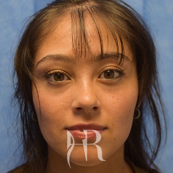 HR Plastic Surgery - Nose Reshaping (Rhinoplasty) patient after 5