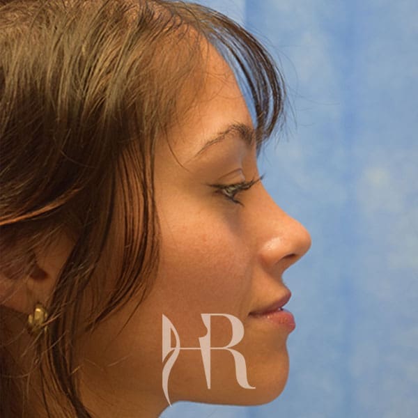 HR Plastic Surgery - Nose Reshaping (Rhinoplasty) patient after 6