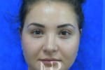 HR Plastic Surgery - Nose Reshaping (Rhinoplasty) patient after 7