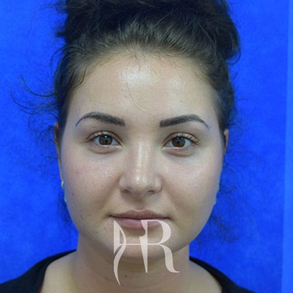 HR Plastic Surgery - Nose Reshaping (Rhinoplasty) patient after 7