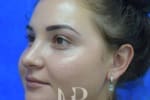 HR Plastic Surgery - Nose Reshaping (Rhinoplasty) patient after 8
