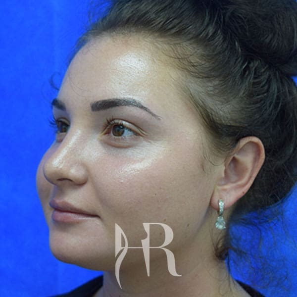 HR Plastic Surgery - Nose Reshaping (Rhinoplasty) patient after 8