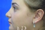HR Plastic Surgery - Nose Reshaping (Rhinoplasty) patient after 9