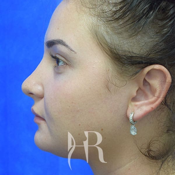 HR Plastic Surgery - Nose Reshaping (Rhinoplasty) patient after 9
