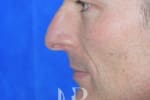 HR Plastic Surgery - Nose Reshaping (Rhinoplasty) patient before 1