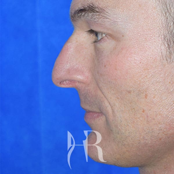 HR Plastic Surgery - Nose Reshaping (Rhinoplasty) patient before 1