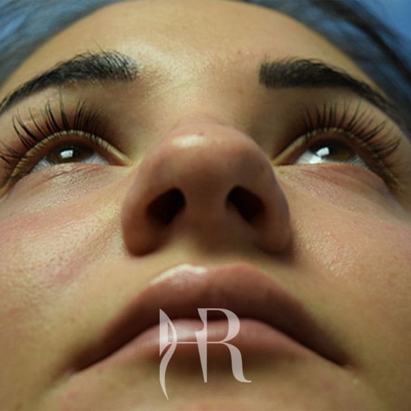 HR Plastic Surgery - Nose Reshaping (Rhinoplasty) patient before 10