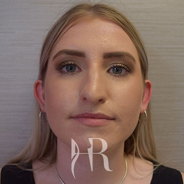 HR Plastic Surgery - Nose Reshaping (Rhinoplasty) patient before 11