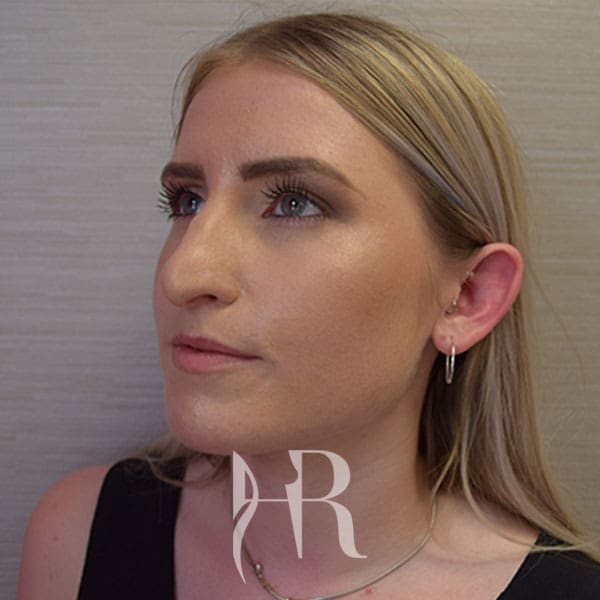 HR Plastic Surgery - Nose Reshaping (Rhinoplasty) patient before 12