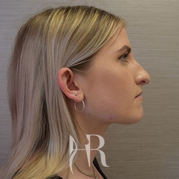 HR Plastic Surgery - Nose Reshaping (Rhinoplasty) patient before 13